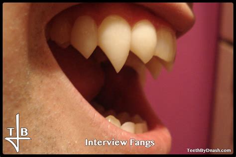 Interview Teeth By Dnash