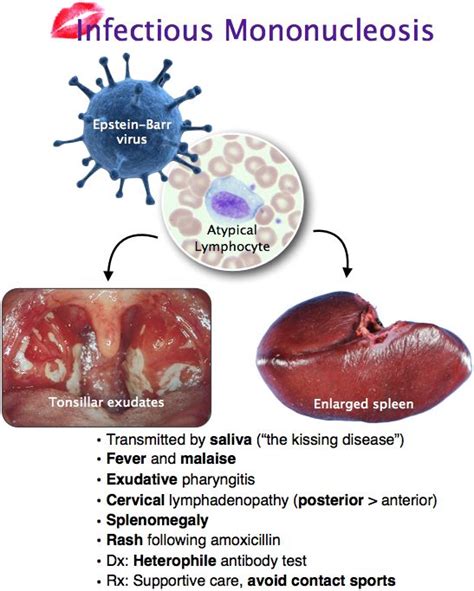Symptoms Of Infectious Mononucleosis Symptoms Of Disease