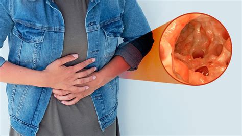 Complications Of Diverticulitis You Should Know About Public