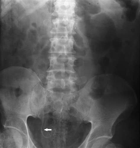 An Extremely Rare Complication Of Ureteral Pigtail Stent Placement A