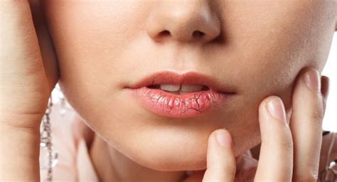 Peeling Lips 12 Natural Treatment And Home Remedies