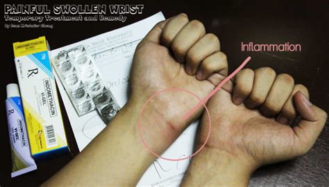 Home Remedy And Treatment For Painful Swollen Wrist Medicines And