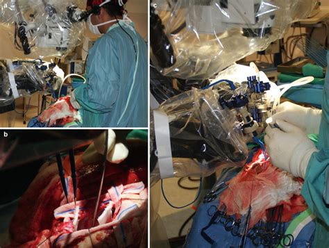 Progress In Neurosurgical Robotics Radiology Key