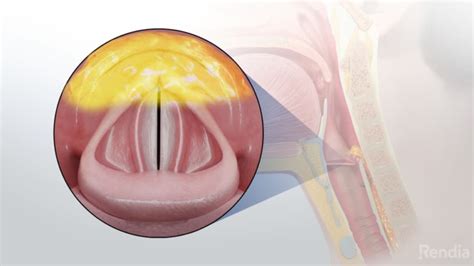 Laryngeal Reflux Overview Entjc