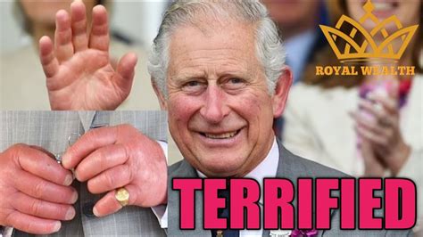 King Charles Sausage Fingers Have Got Worse Doctor Confirms In New