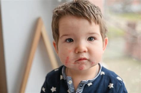 4 Unique Slapped Cheek Syndrome Risk Factors Aetheion®