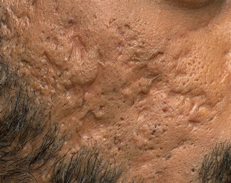 Scarring From Cystic Acne Stock Image C0501008 Science Photo Library