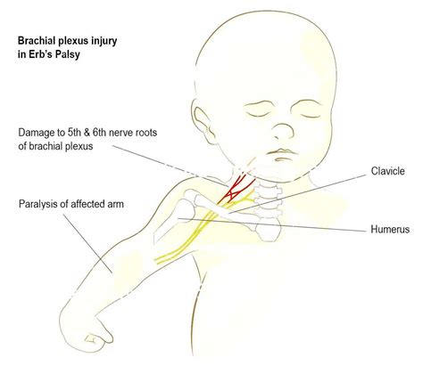 Erb S Palsy