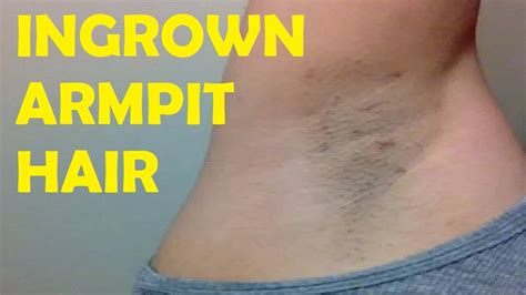How To Get Rid Of Ingrown Armpit Hair Naturally Youtube