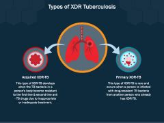 XDR Tuberculosis PowerPoint Template And Google Slides Theme