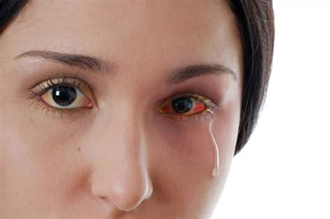 Increasing Eye Allergy With Increasing Pollution Eye Health Nepal