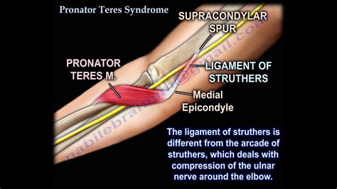 Pronator Teres Syndrome Everything You Need To Know Dr Nabil