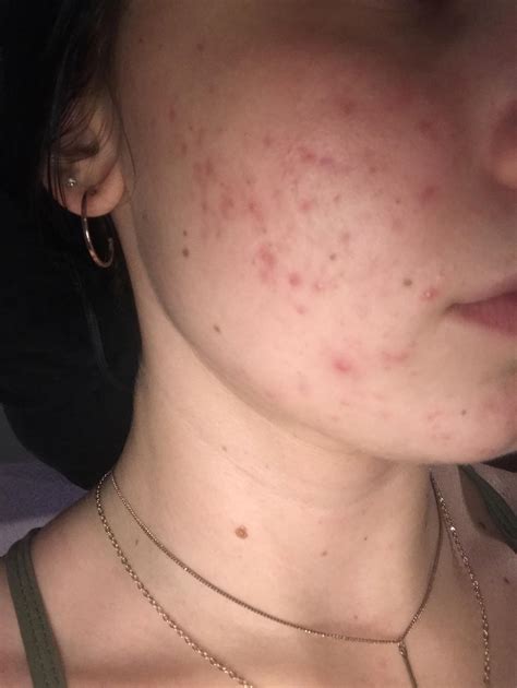 Does This Look Like Acne Scars These Have Been Here Forever And They