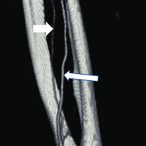 Radial Artery Howmed