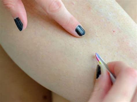 Ingrown Hair Causes Symptoms How To Remove And Prevent Nubo Beauty