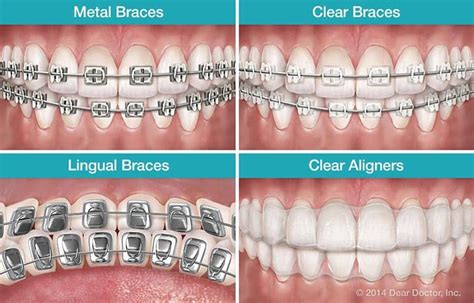What Dental Issues Do Braces Correct And Prevent Lineberger Orthodontics