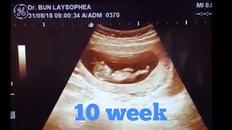 ពិនិត្យឣេកូផ្ទៃពោះ 2ខែ កន្លះ 6ថ្ងៃ Pregnancy Ultrasound 10 Week 6day By