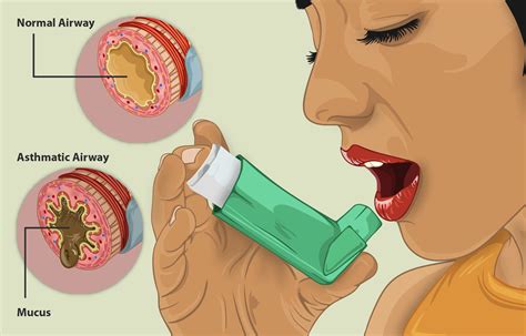 When you have asthma, not only do your airways become narrow, but it also produces more mucus, which makes it extremely difficult for. Asthma- Causes, Symptoms, Types, Diagnosis, Treatment ...