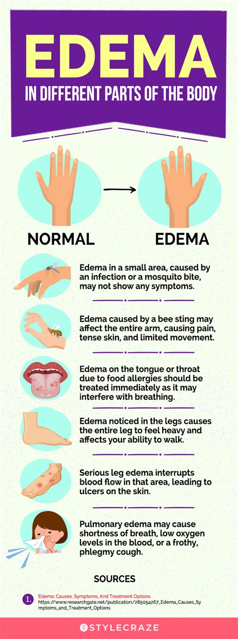 25 Remedies To Treat Edema Naturally Signs Causes And Types