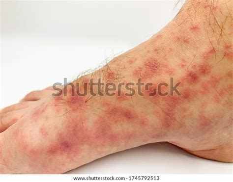 Close Males Foot Toes Red Rash Stock Photo Edit Now 1745792513