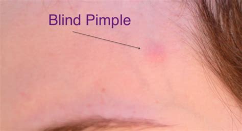 How To Get Rid Of Blind Pimples Stylish Life For Moms