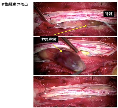 Look up in linguee suggest as a translation of 脊髄 脊髄腫瘍│脊椎・脊髄班の症例など│浜松医科大学 整形外科学 ...