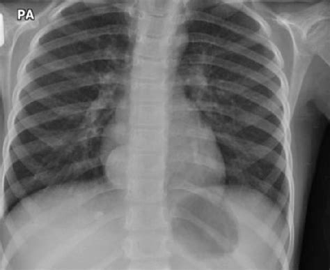 Chest X Ray Showing A Lesion In The Right Hemithorax Situated Within
