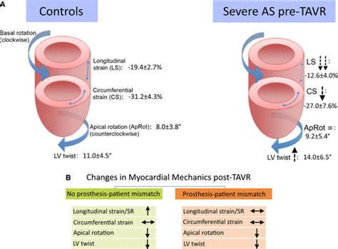 Impact Of Prosthesis‐patient Mismatch On Left Ventricular Myocardial