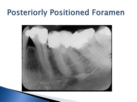 Ppt Eo Normal Intraoral Radiographic Anatomy Powerpoint