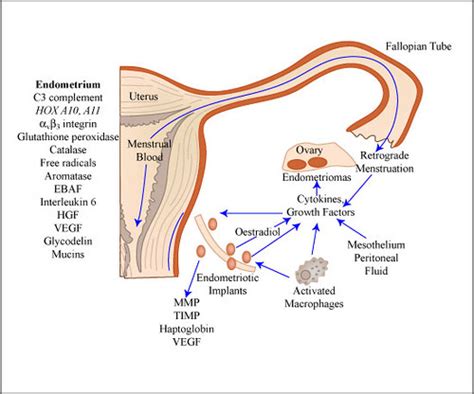 Model Of Endometriosis Development Model Of Endometriosis Flickr