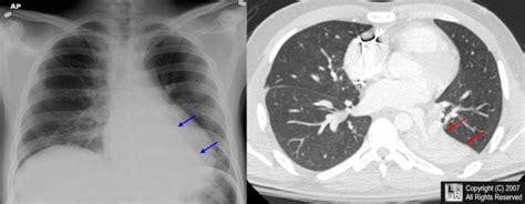 Learning Radiology Atelectasis Left Lower Lobe Lll