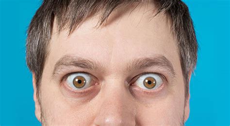 Common Causes Of Bulging Eyes And How To Treat Them Dry Eye Center At