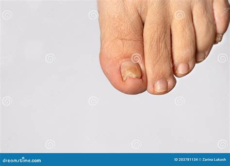 Fungus Of Nails On The Big Toe Dermatomycosis And Onychomycosis