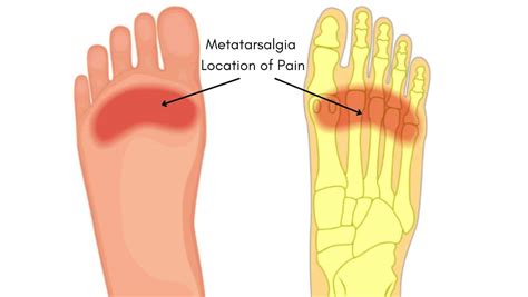 Metatarsalgia Symptoms Diagnosis And Treatment By A Physical Therapist