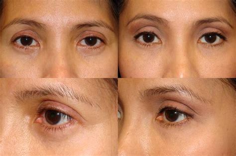 Eyelid Fat Grafting Cosmetic Eyelid Surgery In Beverly Hills Dr