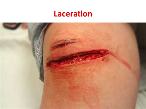 laceration - Liberal Dictionary