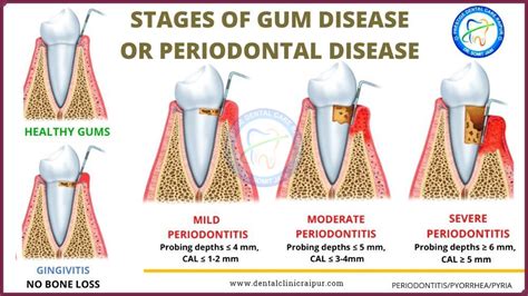 Periodontitis And Gingivitis Meaning Symptoms Tx Gum Disease