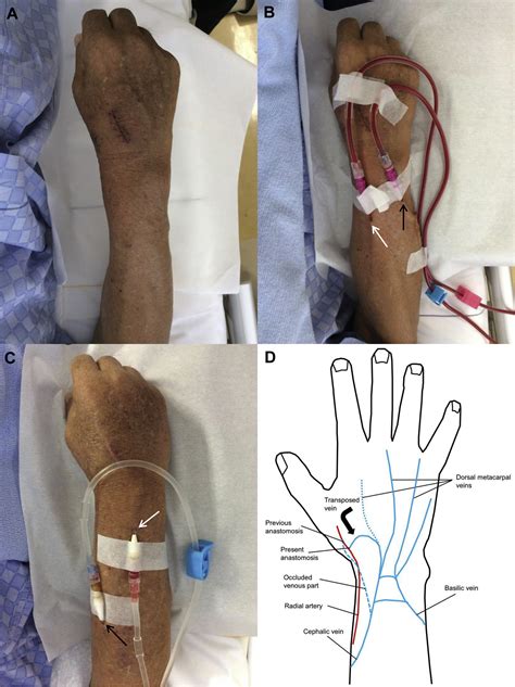 Use Of The Dorsal Vein Of The Hand For Arteriovenous Fistula Creation