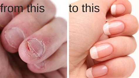 Why does my cat bite me? How to Stop Biting Your Nails ★ Break The Habit ...