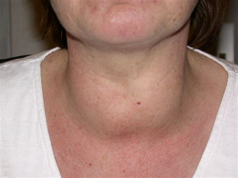 What Are The Risk Factors For Thyroid Cancer Quora