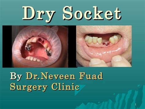 Dry Socket