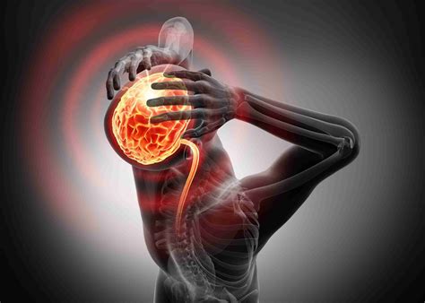 Idiopathic Intracranial Hypertension Symptoms Causes And Treatment
