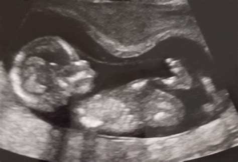 My Ultrasound Baby Smile And Carry On