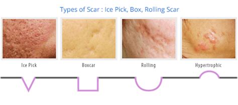 Scars And Stretch Marks Skin By Design