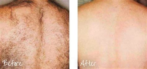 Maybe you would like to learn more about one of these? Portland Laser Hair Removal Treatment - VanderVeer Center