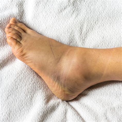 Doctors Explain All The Reasons You May Be Dealing With Swollen Ankles