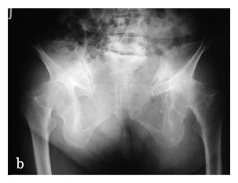 Anteroposterior Radiographs Of The Bilateral Hip Joints On Lying A
