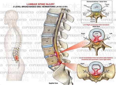 2 Level L4 5 L5 S1 Lumbar Disc Herniations Medical Art Works