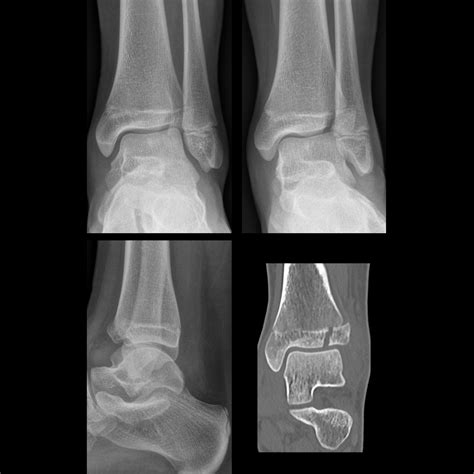 Salter Harris Fracture Pediatric Radiology Reference Article