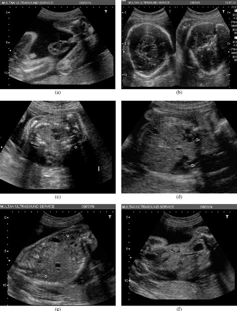 Pdf Ultrasound Diagnosis Of Cephalopagus Conjoined Twin Pregnancy At